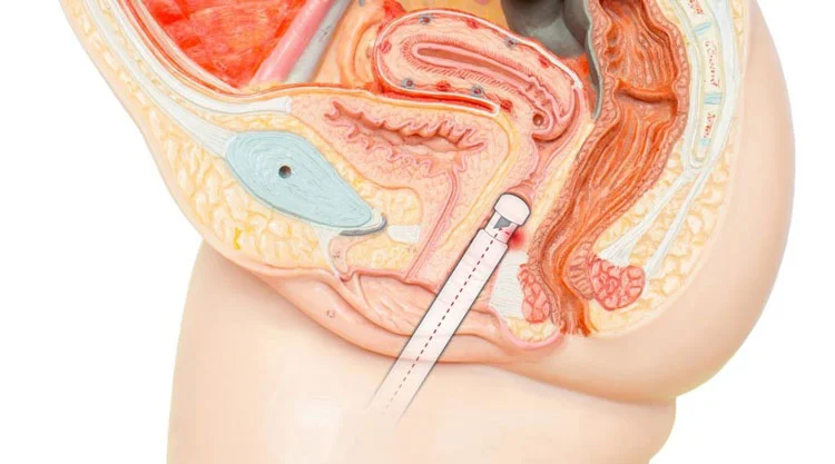 ئ/هزینه لیزر بی اختیاری ادرار