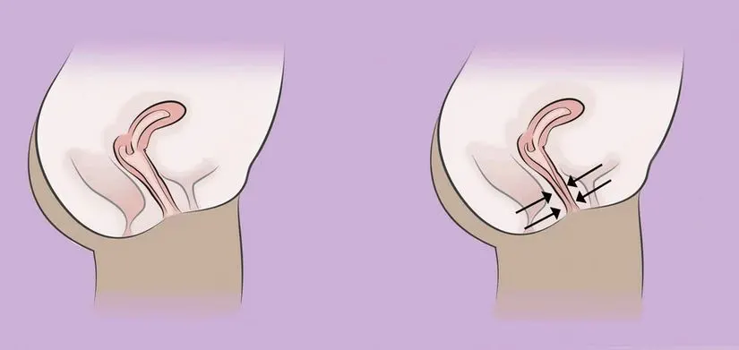 m/درمان قطعی واژینیسموس