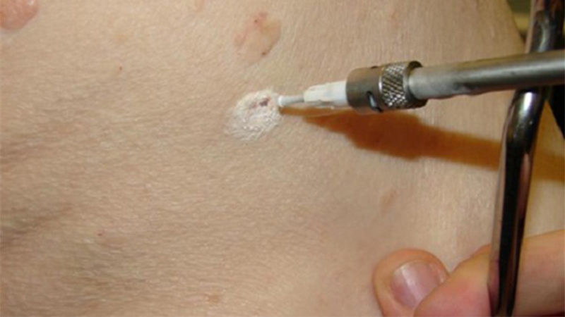 m/هزینه برداشتن زگیل با لیزر