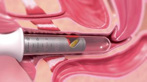 m/هزینه لیزر بی اختیاری ادرار