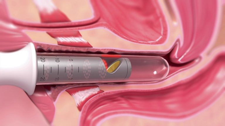 m/هزینه لیزر بی اختیاری ادرار